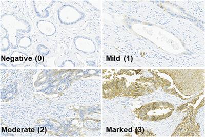 GLUT-1 may predict metastases and death in patients with locally advanced rectal cancer